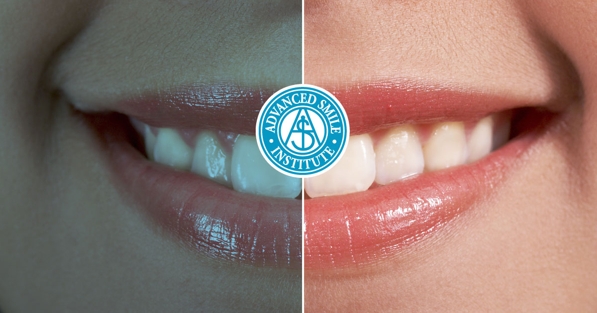 Advanced Smile Institute Dentistry Before And After Photos Port St Lucie FL