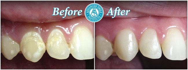 Cosmetic Bonding Before And After Photos