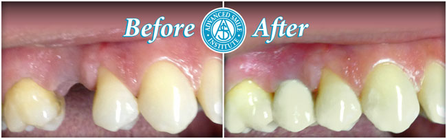 Dental Implants Before And After Photos