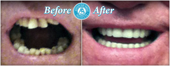 Full Mouth Restoration Before And After Photos