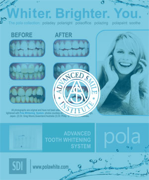 Advanced Teeth Whitening Port St. Lucie, FL