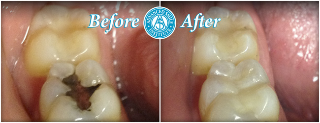 Tooth Filling Replacement Before And After Photos